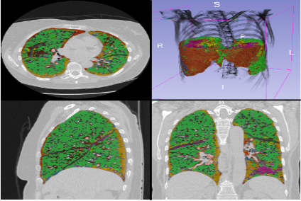 imágenes de tomografía computarizada