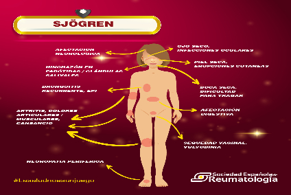 SER Sjögren